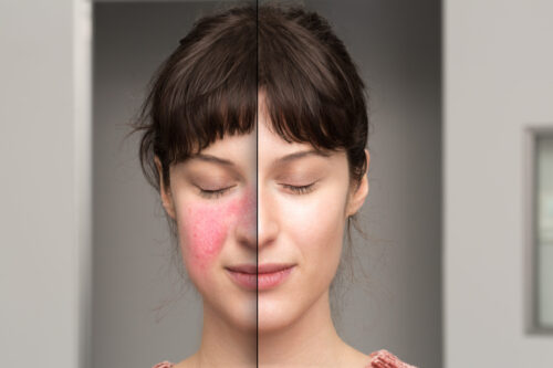 Rosacea
